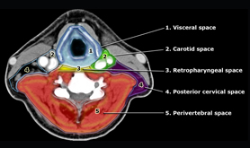 Neck CT Scan